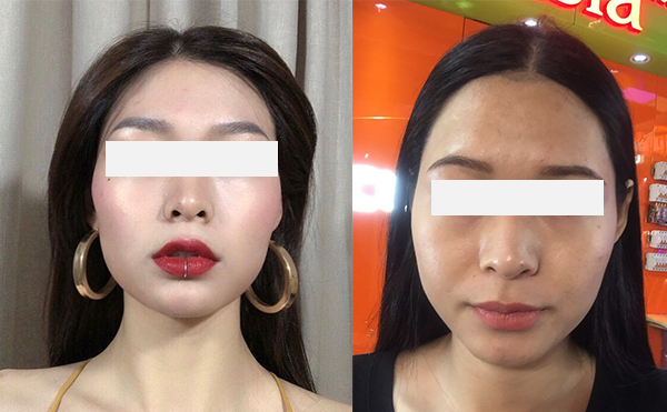 激光脫發(fā)際線效果怎么樣？