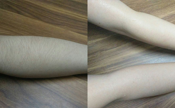 冰點手臂脫毛會傷害皮膚嗎？