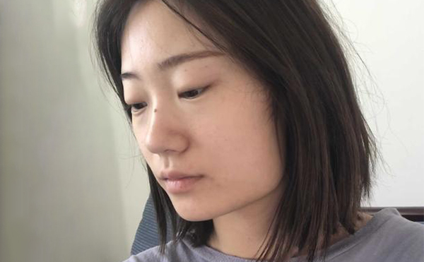 下頜角整形適宜人群有哪些？