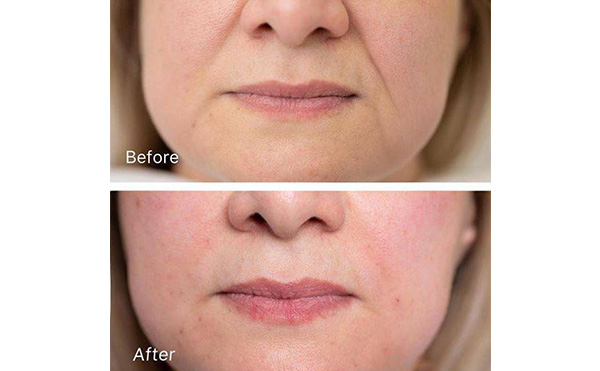 玻尿酸去法令紋安全嗎？