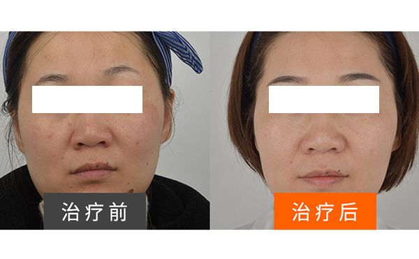 彩光嫩膚安全不安全?