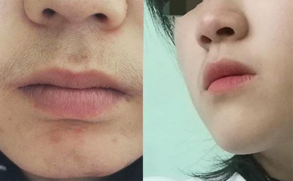 面部激光脫毛有什么優(yōu)勢？