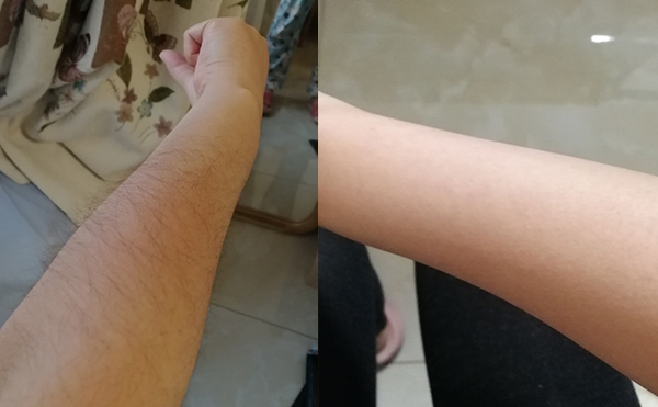 光子手臂脫毛幾次能脫完？