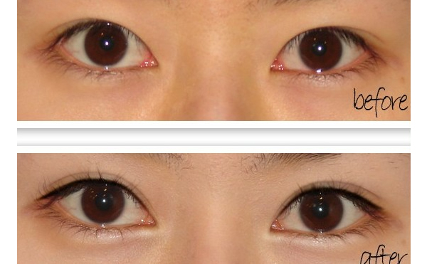 開眼角手術(shù)有什么原則？