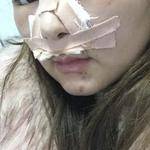 鼻基底整形案例對(duì)比3