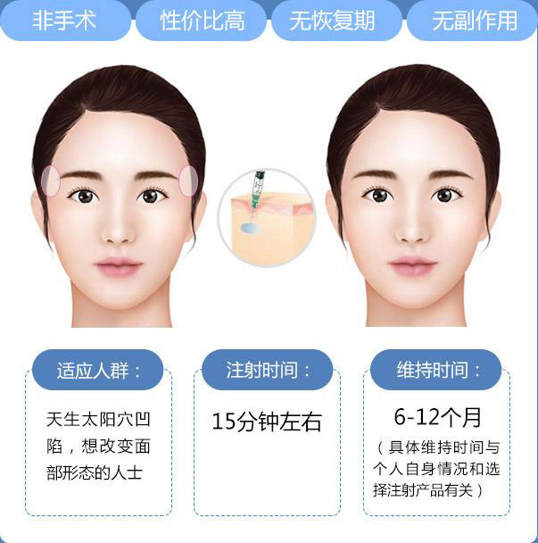豐太陽穴多少錢？