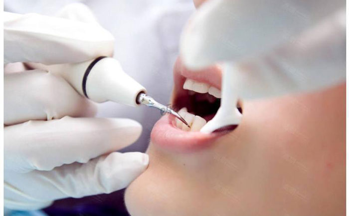 超聲洗牙價格是多少？超聲洗牙對牙齒有傷害嗎？