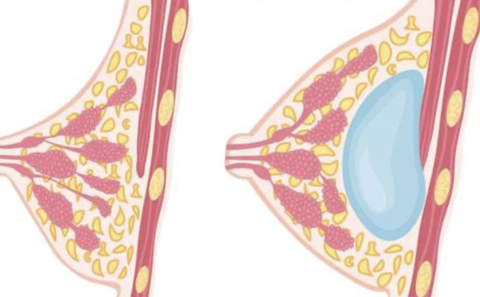 硅膠假體豐胸需要多少錢？硅膠假體豐胸可以保持多久？