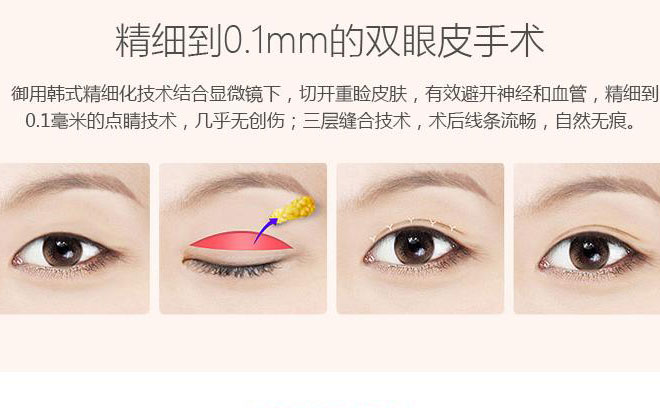 韓式三點雙眼皮一般要多少錢？