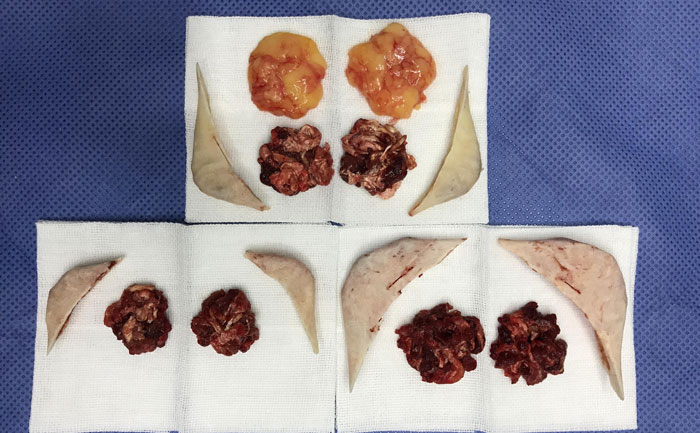 磨骨瘦臉費(fèi)用多少錢？