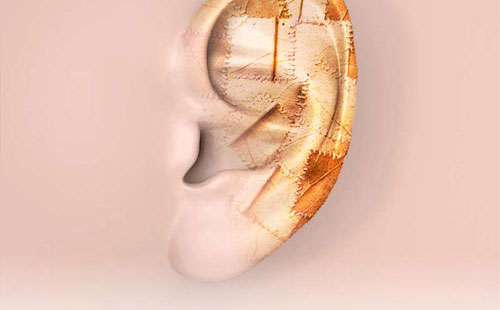 全耳再造術(shù)多少錢？全耳再造需要多久時間？