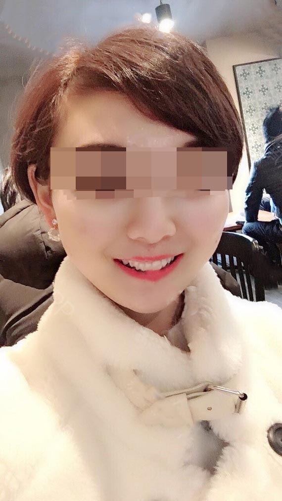 下頜角整形效果1