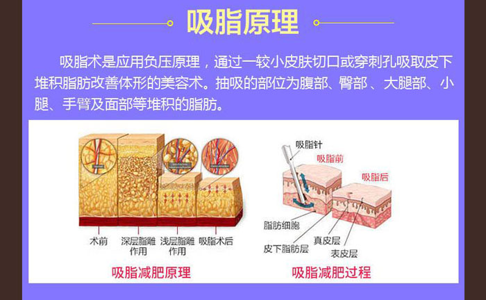 水動(dòng)力吸脂效果好嗎？