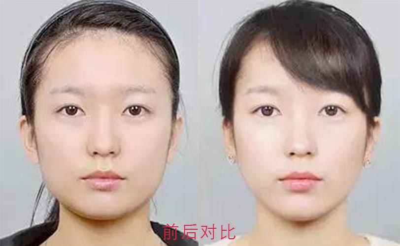 面部吸脂前后效果對(duì)比