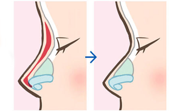 隆鼻假體什么時候取出較好?更換的話是必須要換新的嗎?