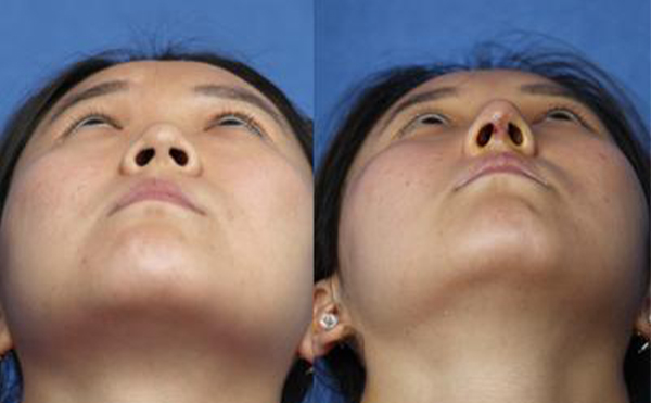 隆鼻手術失敗的表現(xiàn)有哪些?術后護理有哪些?