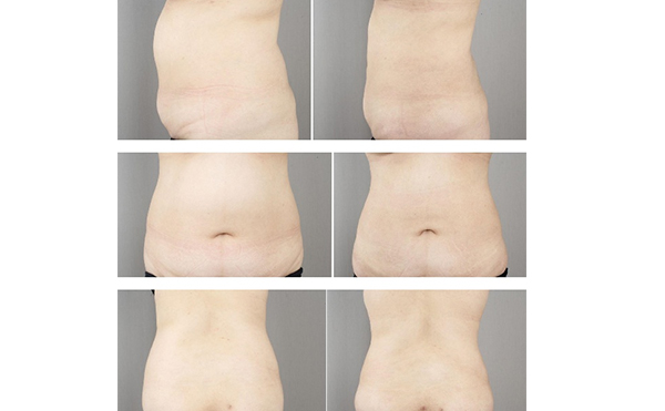 產后多久可以做腹部吸脂？