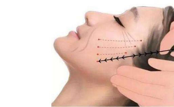 線雕提升適合哪些人做？