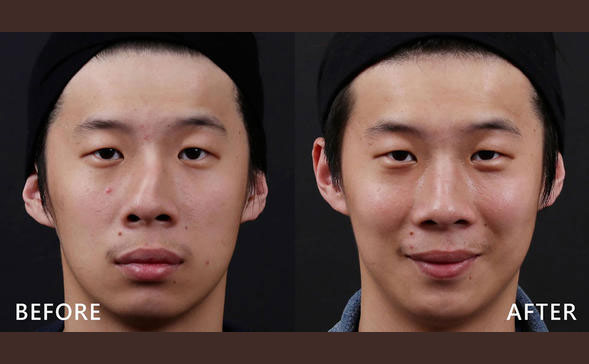 鼻骨矯正手術(shù)多少錢？鼻骨矯正手術(shù)危險(xiǎn)嗎？