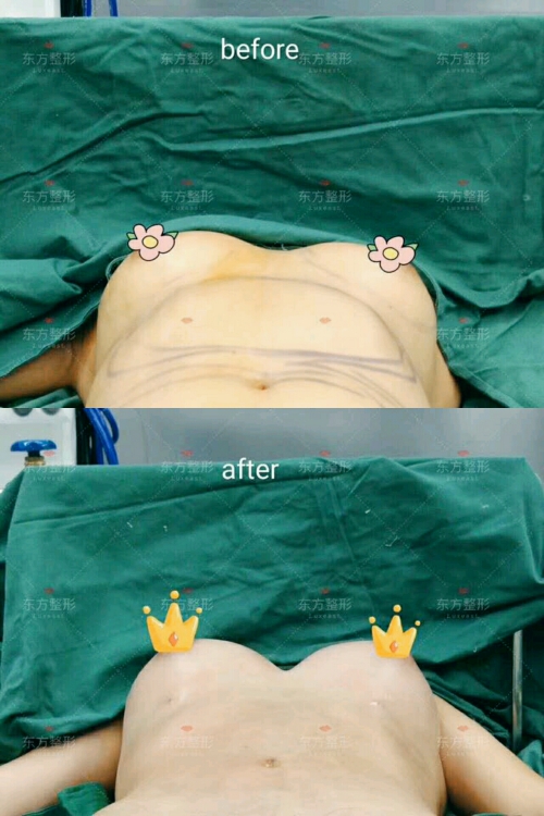 廣西南寧東方整形術后即刻效果