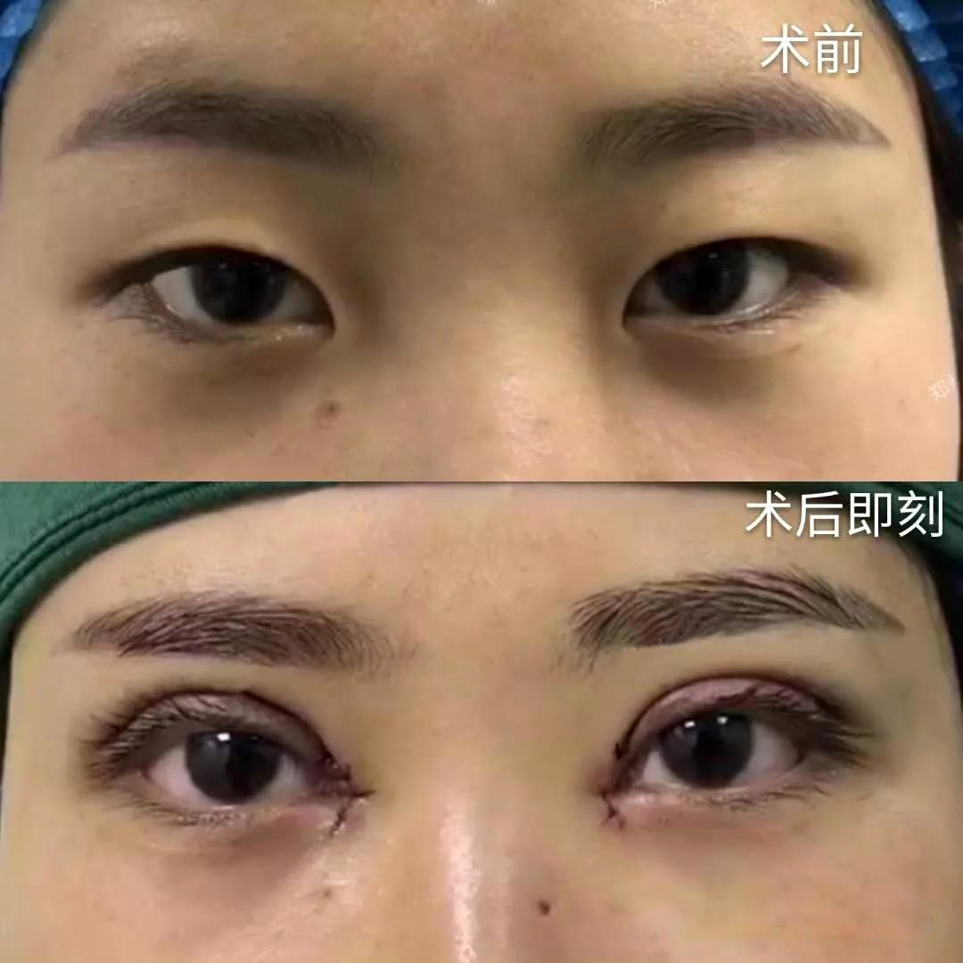 于世川做雙眼皮案例效果對比圖2