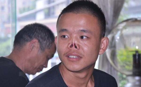 鼻再造手術(shù)有什么風(fēng)險?