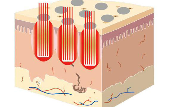 點(diǎn)陣激光祛斑后多久消失？