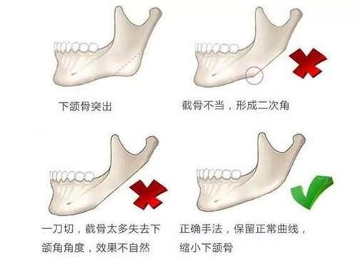 合肥藝星周海林醫(yī)生手術(shù)示意圖