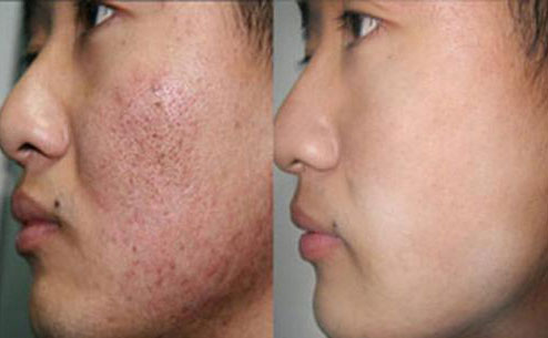 痘坑修復(fù)激光手術(shù)大概要多少錢？