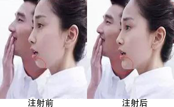 膨體隆下巴容易引發(fā)感染嗎?恢復(fù)后手術(shù)切口會(huì)不會(huì)被人被看出來(lái)?