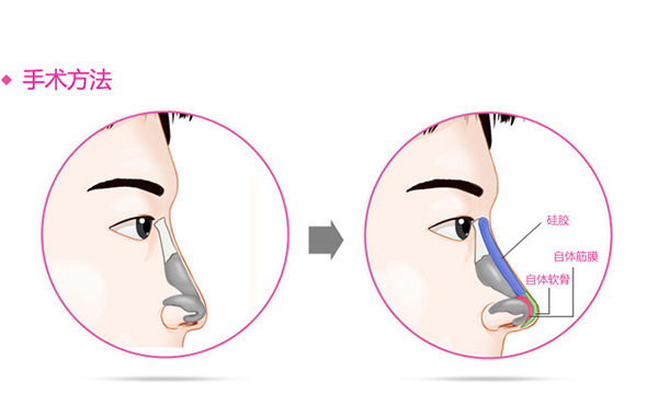 假體隆鼻的優(yōu)點(diǎn)