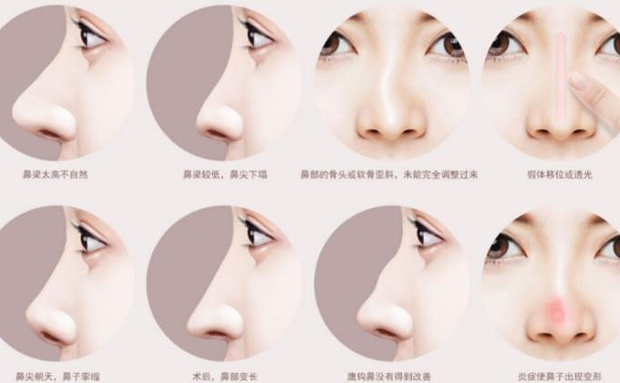 鼻尖整形大概多少錢？