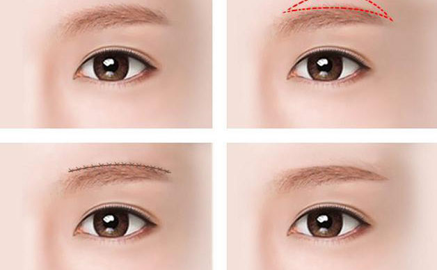 切眉除皺效果好嗎？