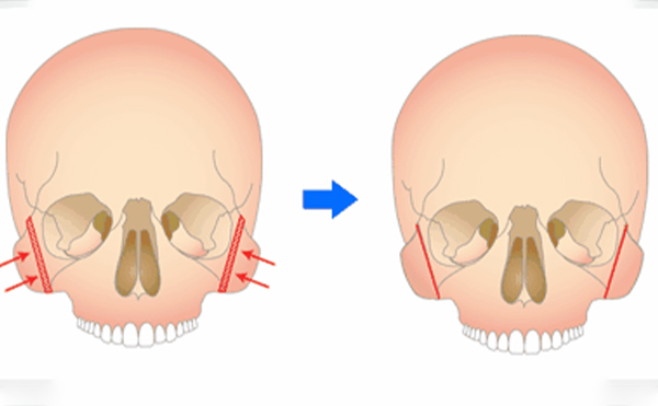 顴骨整形手術(shù)安不安全？有危險嗎？