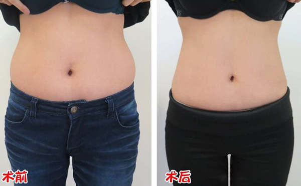 腹部吸脂效果如何?