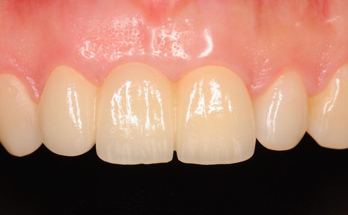 門牙種植牙需要多少錢一顆？