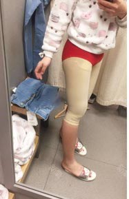 太原時光整形王國軍大腿吸脂案例2