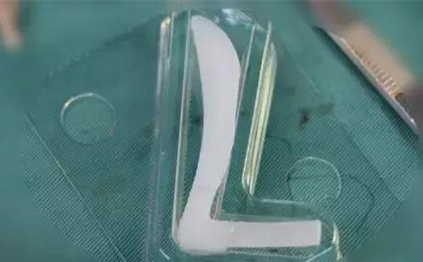 隆鼻假體取出后鼻子會(huì)變形嗎?