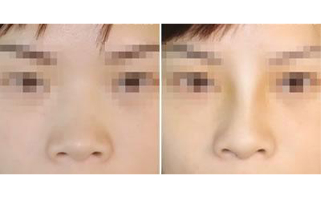 做隆鼻手術(shù)會留疤嗎？