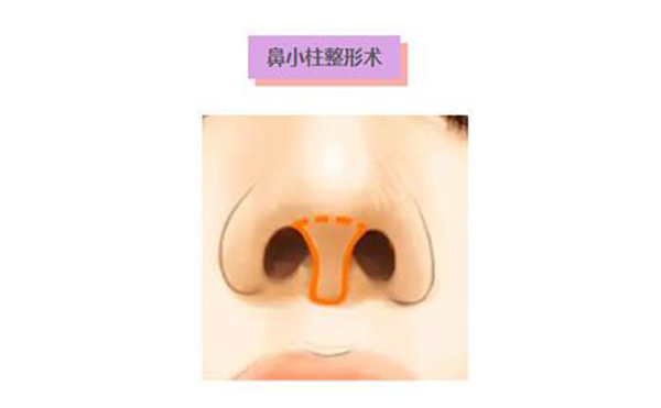 鼻小柱延長(zhǎng)術(shù)是什么？鼻小柱延長(zhǎng)手術(shù)有什么優(yōu)點(diǎn)