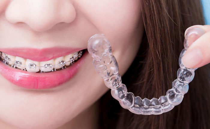 隱形牙套價(jià)格多少錢？