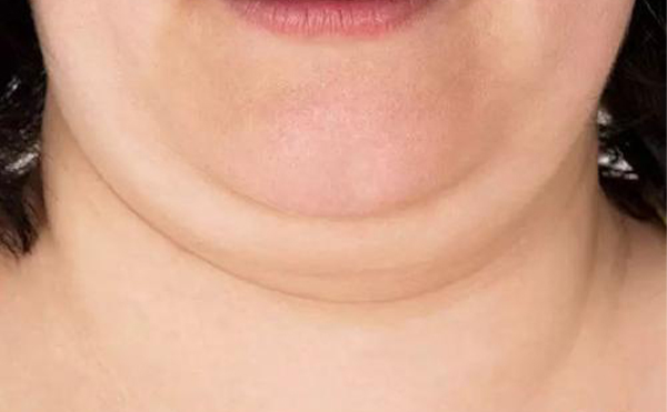 人為什么會有雙下巴