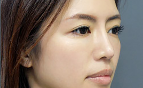 嘉興藝星整形：隆鼻失敗九大表現(xiàn)，快看看你有沒有