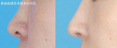 南京美貝爾做鼻基底效果術(shù)前術(shù)后對(duì)比