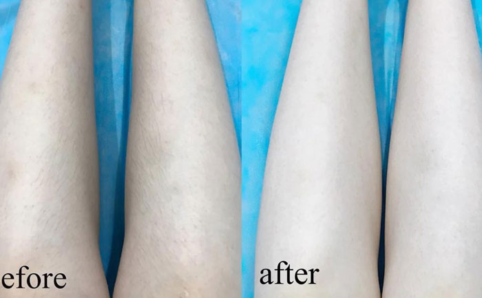 激光脫毛能永久脫毛嗎？