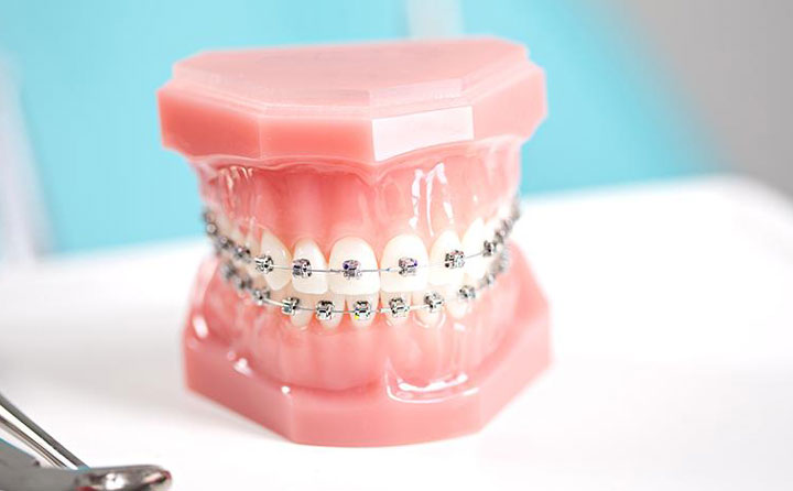 牙齒正畸費用一般多少？