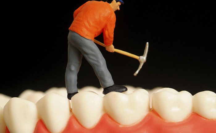 鑲牙要多少錢一顆費用？