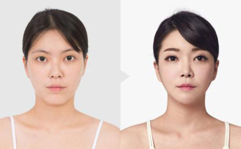 韓式埋線雙眼皮多久恢復自然？