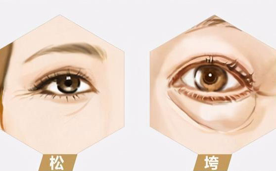 無痛去眼袋價(jià)格多少錢？