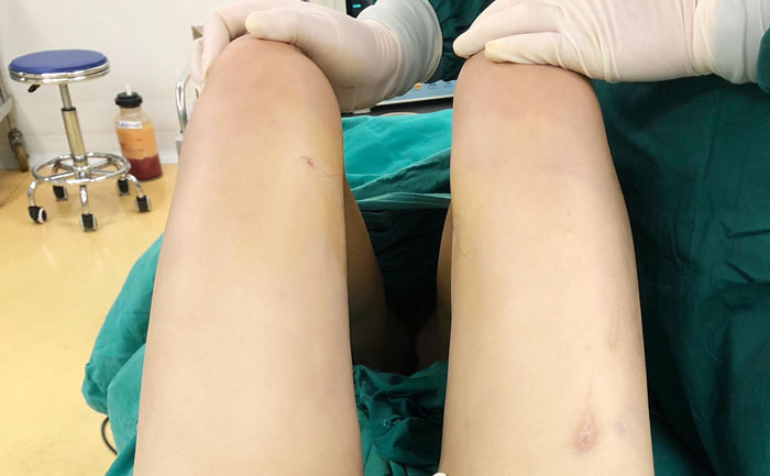 腿部吸脂手術(shù)多少錢？腿部吸脂會(huì)不會(huì)留下后遺癥？